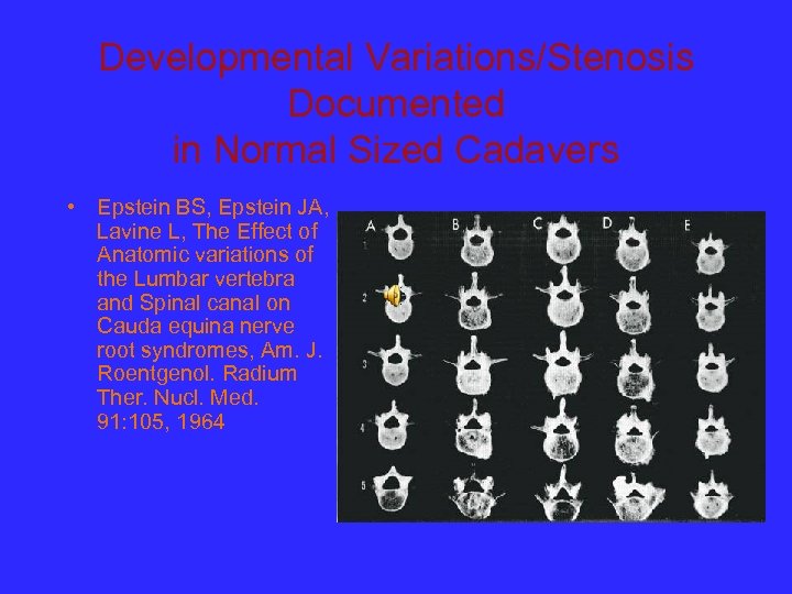 Developmental Variations/Stenosis Documented in Normal Sized Cadavers • Epstein BS, Epstein JA, Lavine L,