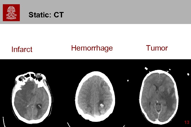 Static: CT Infarct Hemorrhage Tumor 13 