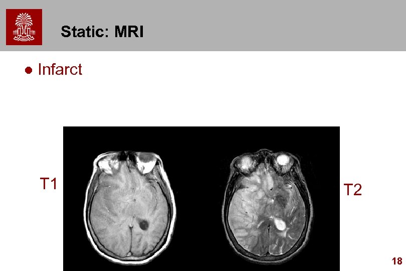 Static: MRI l Infarct T 1 T 2 18 