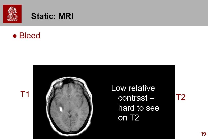 Static: MRI l Bleed T 1 Low relative contrast – hard to see on