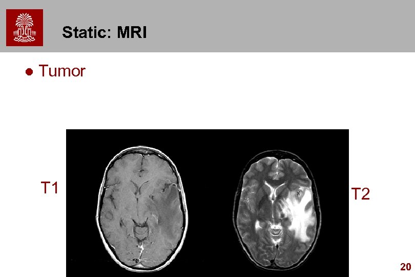 Static: MRI l Tumor T 1 T 2 20 