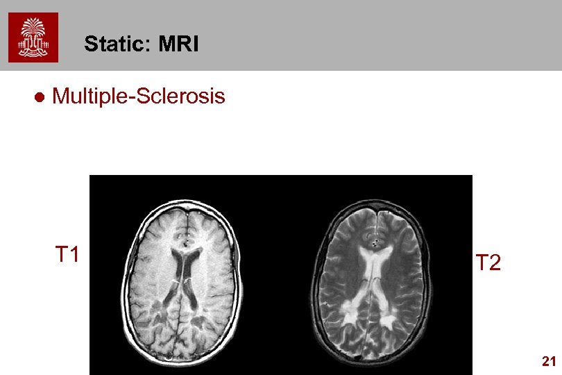 Static: MRI l Multiple-Sclerosis T 1 T 2 21 