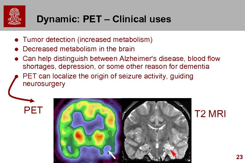 Dynamic: PET – Clinical uses l l Tumor detection (increased metabolism) Decreased metabolism in