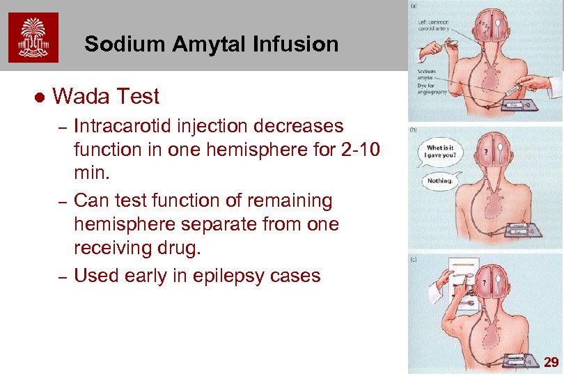 Sodium Amytal Infusion l Wada Test – – – Intracarotid injection decreases function in