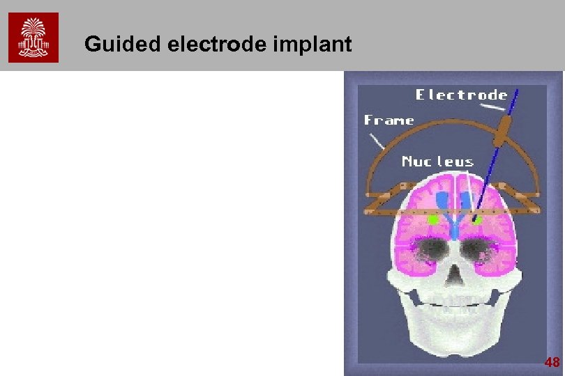 Guided electrode implant 48 