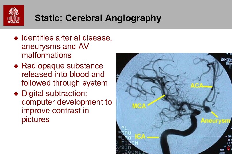 Static: Cerebral Angiography l l l Identifies arterial disease, aneurysms and AV malformations Radiopaque