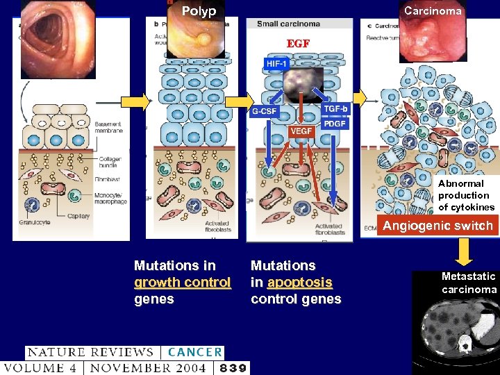 Polyp Carcinoma EGF Abnormal production of cytokines Angiogenic switch Mutations in growth control genes