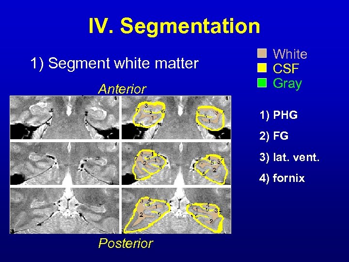 IV. Segmentation 1) Segment white matter Anterior White CSF Gray 1) PHG 2) FG