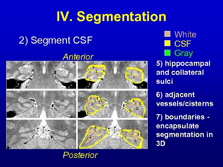 IV. Segmentation 2) Segment CSF Anterior White CSF Gray 5) hippocampal and collateral sulci