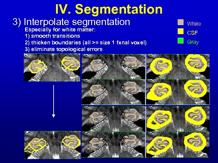 IV. Segmentation 3) Interpolate segmentation Especially for white matter: 1) smooth transitions 2) thicken