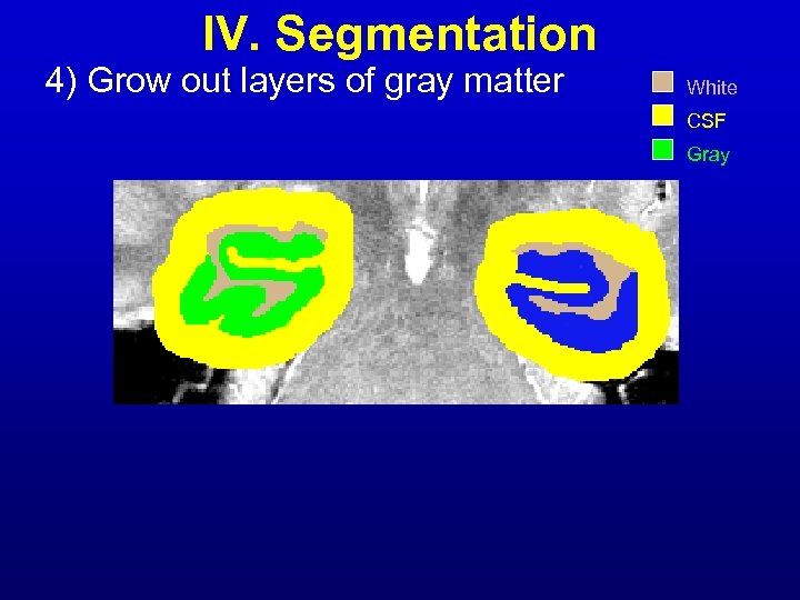 IV. Segmentation 4) Grow out layers of gray matter White CSF Gray 