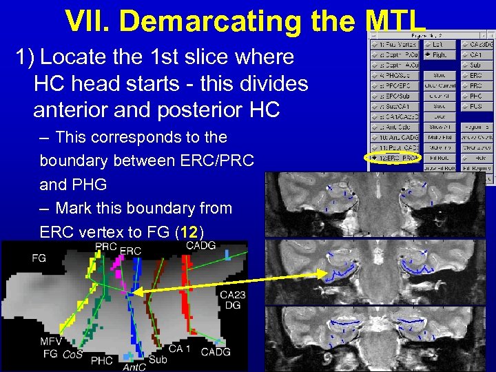 VII. Demarcating the MTL 1) Locate the 1 st slice where HC head starts