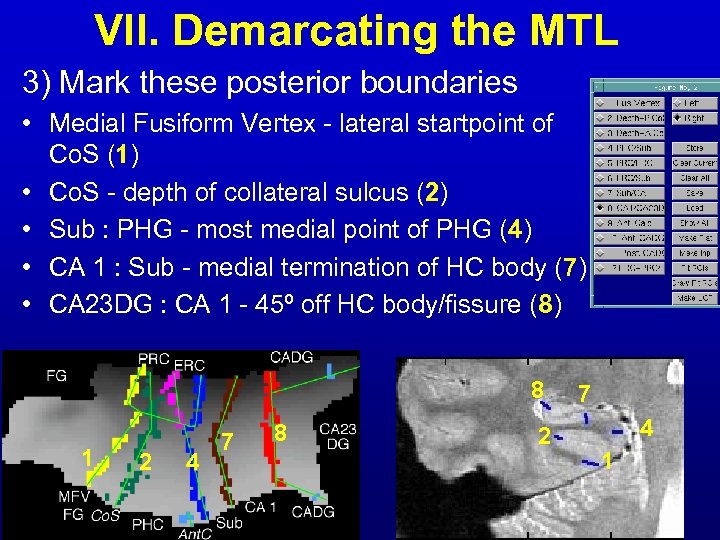 VII. Demarcating the MTL 3) Mark these posterior boundaries • Medial Fusiform Vertex -