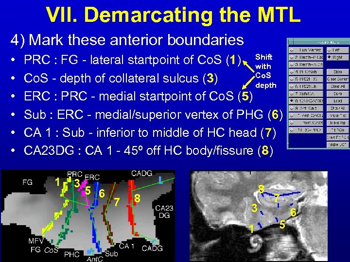 VII. Demarcating the MTL 4) Mark these anterior boundaries • • • PRC :