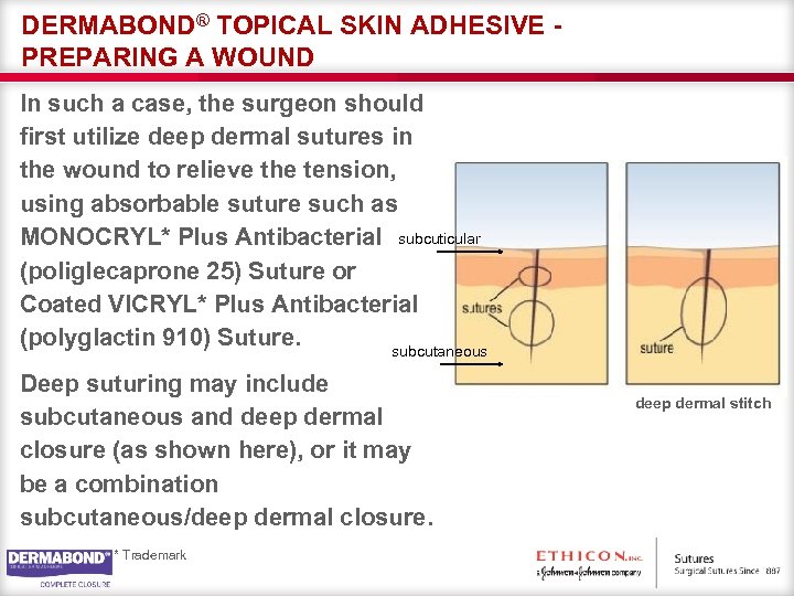 DERMABOND® TOPICAL SKIN ADHESIVE PREPARING A WOUND In such a case, the surgeon should