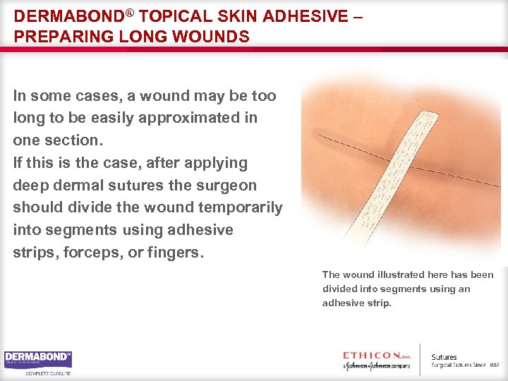 DERMABOND® TOPICAL SKIN ADHESIVE – PREPARING LONG WOUNDS In some cases, a wound may