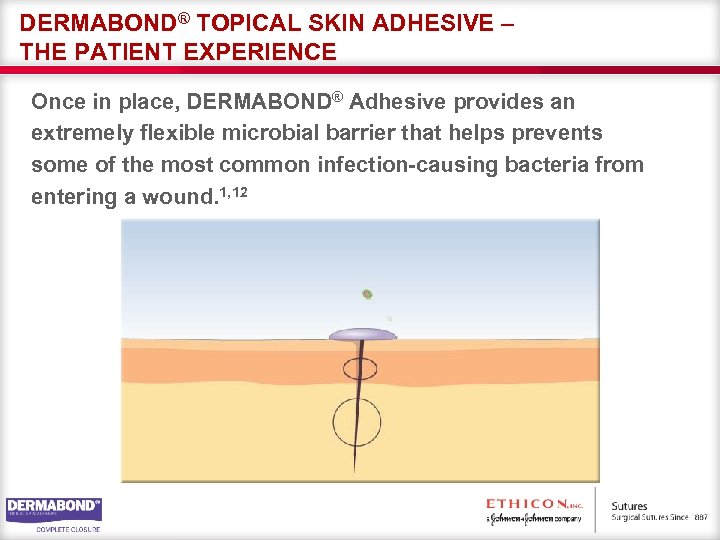 DERMABOND® TOPICAL SKIN ADHESIVE – THE PATIENT EXPERIENCE Once in place, DERMABOND® Adhesive provides