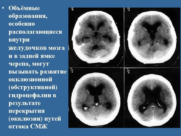  • Объёмные образования, особенно располагающиеся внутри желудочков мозга и в задней ямке черепа,