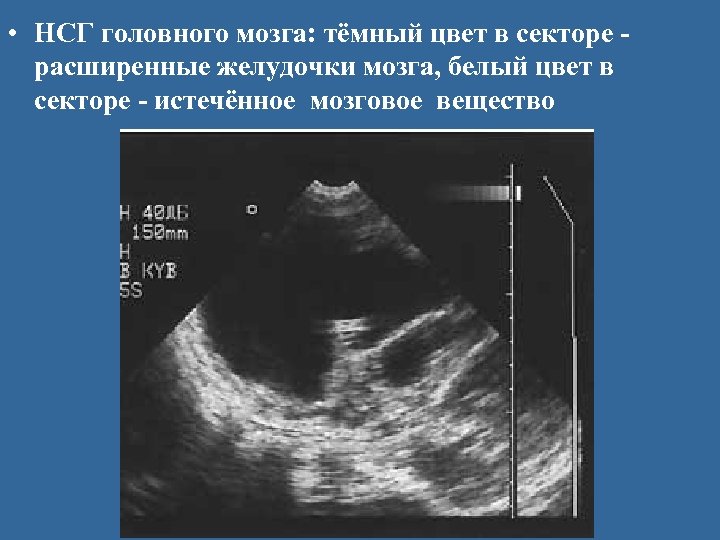  • НСГ головного мозга: тёмный цвет в секторе расширенные желудочки мозга, белый цвет