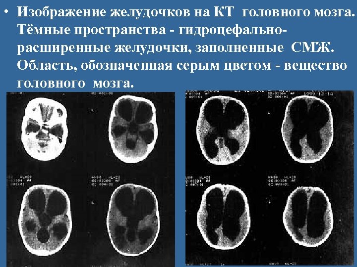  • Изображение желудочков на КТ головного мозга. Тёмные пространства - гидроцефальнорасширенные желудочки, заполненные