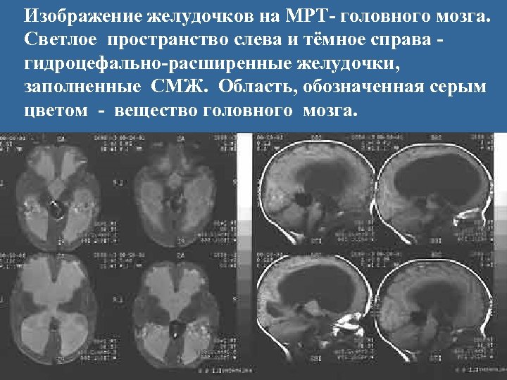 Изображение желудочков на МРТ- головного мозга. Светлое пространство слева и тёмное справа гидроцефально-расширенные желудочки,