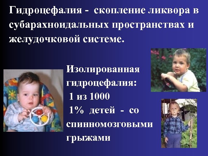 Гидроцефалия - скопление ликвора в субарахноидальных пространствах и желудочковой системе. Изолированная гидроцефалия: 1 из