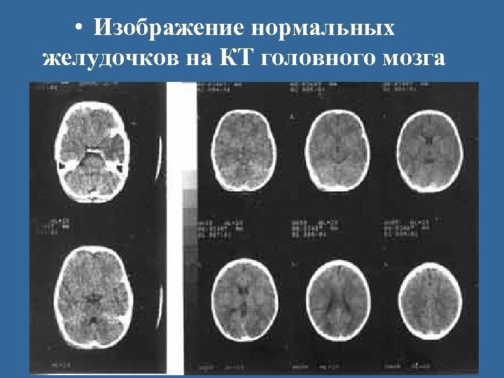  • Изображение нормальных желудочков на КТ головного мозга 