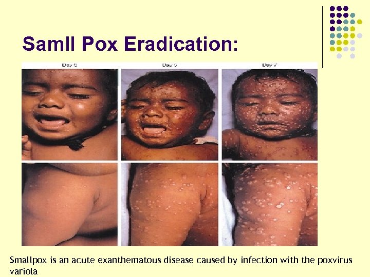Samll Pox Eradication: Smallpox is an acute exanthematous disease caused by infection with the