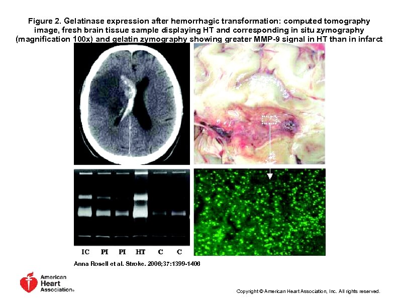 Figure 2. Gelatinase expression after hemorrhagic transformation: computed tomography image, fresh brain tissue sample