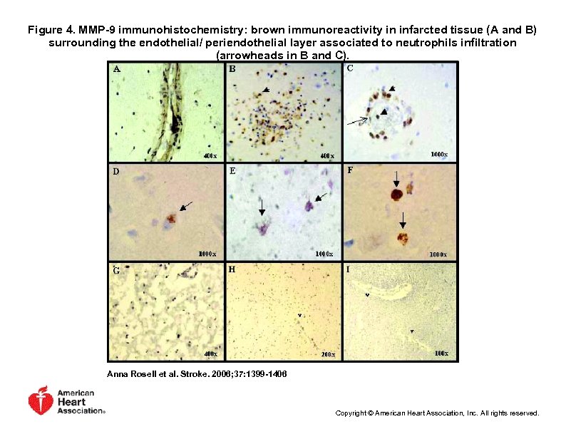 Figure 4. MMP-9 immunohistochemistry: brown immunoreactivity in infarcted tissue (A and B) surrounding the