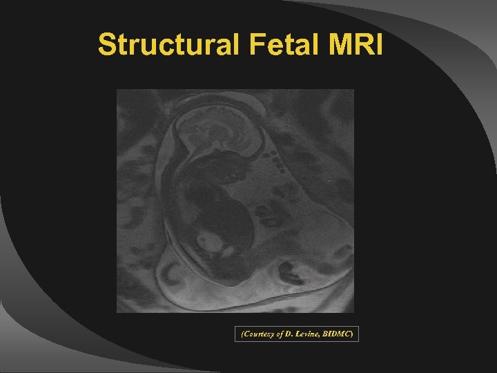 Structural Fetal MRI (Courtesy of D. Levine, BIDMC) 