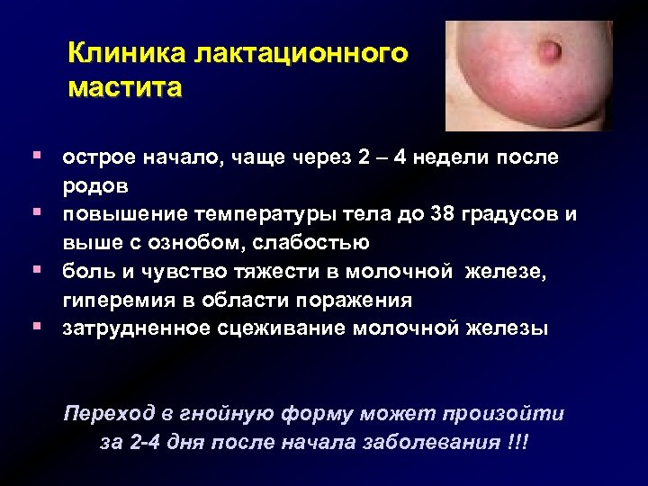 Клиника лактационного мастита § острое начало, чаще через 2 – 4 недели после родов