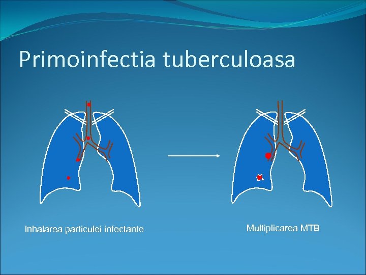 Primoinfectia tuberculoasa Inhalarea particulei infectante Multiplicarea MTB 