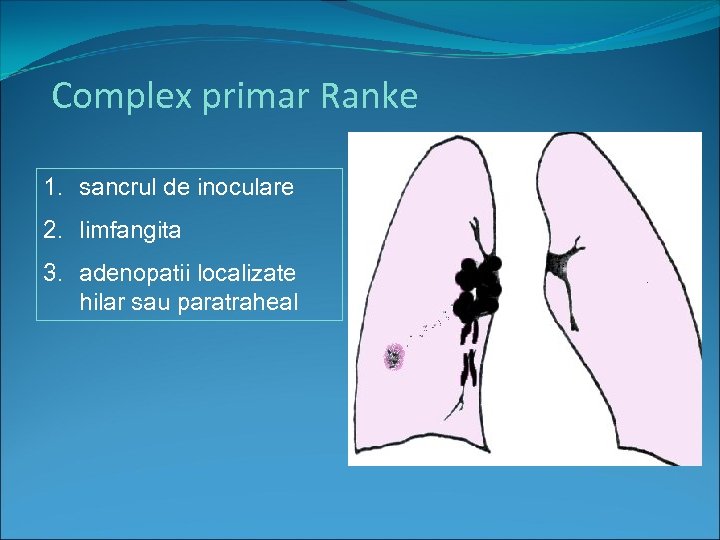 Complex primar Ranke 1. sancrul de inoculare 2. limfangita 3. adenopatii localizate hilar sau