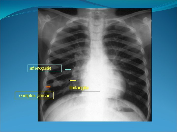 adenopatie limfangita complex primar 
