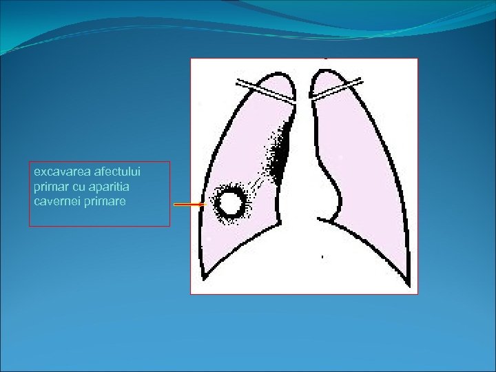 excavarea afectului primar cu aparitia cavernei primare 