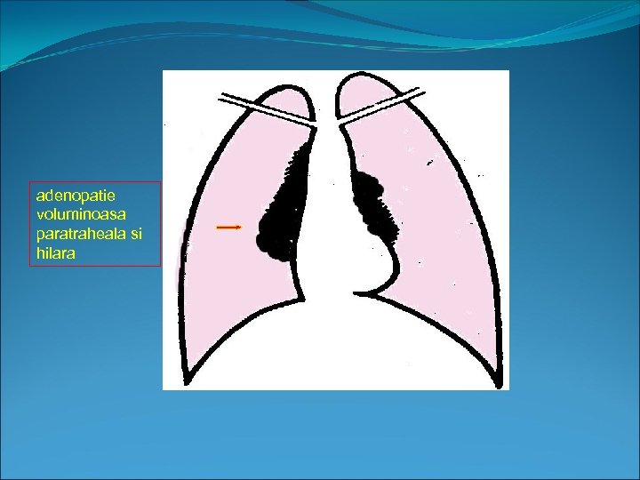 adenopatie voluminoasa paratraheala si hilara 