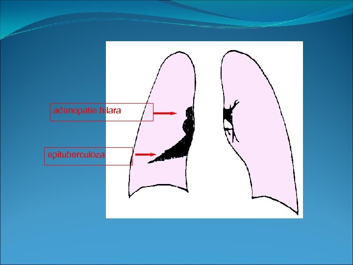 adenopatie hilara epituberculoza 