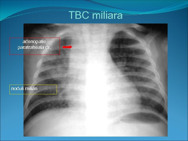 TBC miliara adenopatie paratraheala dr. noduli miliari 