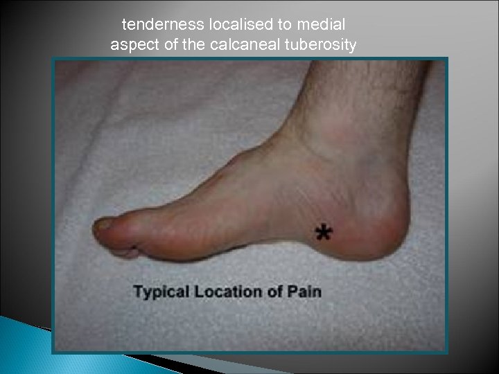 tenderness localised to medial aspect of the calcaneal tuberosity 