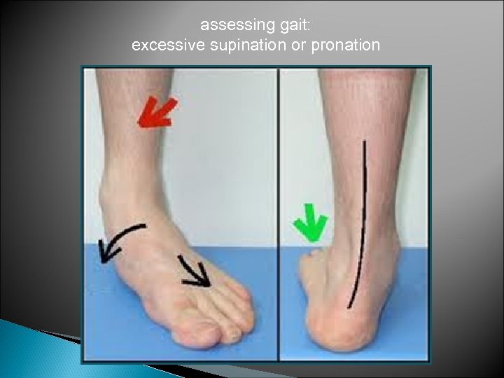 assessing gait: excessive supination or pronation 