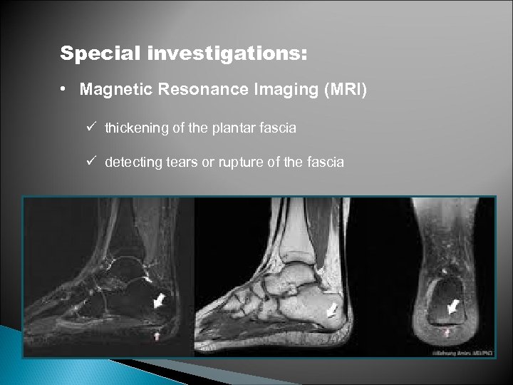 Special investigations: • Magnetic Resonance Imaging (MRI) ü thickening of the plantar fascia ü