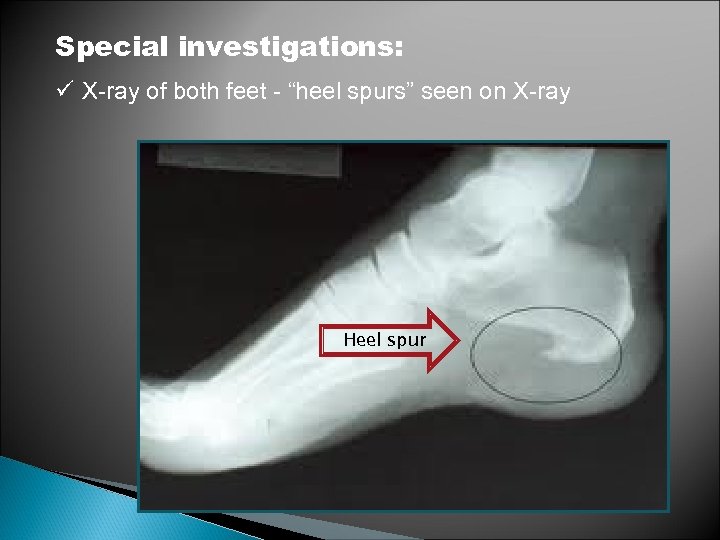 Special investigations: ü X-ray of both feet - “heel spurs” seen on X-ray Heel