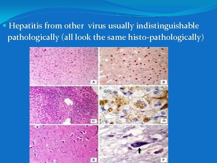  Hepatitis from other virus usually indistinguishable pathologically (all look the same histo-pathologically) 