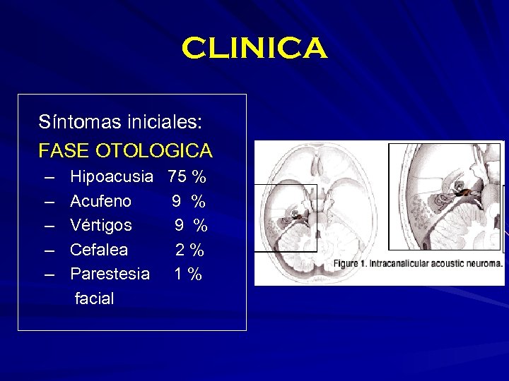 CLINICA Síntomas iniciales: FASE OTOLOGICA – – – Hipoacusia 75 % Acufeno 9 %