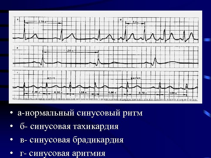  • • а-нормальный синусовый ритм б- синусовая тахикардия в- синусовая брадикардия г- синусовая