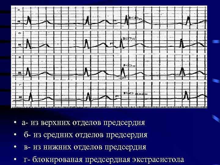  • • а- из верхних отделов предсердия б- из средних отделов предсердия в-