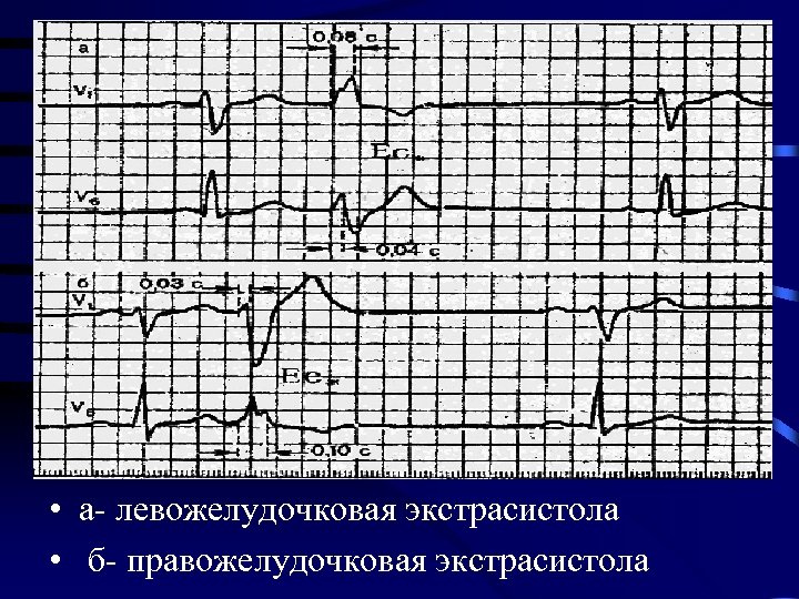  • а- левожелудочковая экстрасистола • б- правожелудочковая экстрасистола 