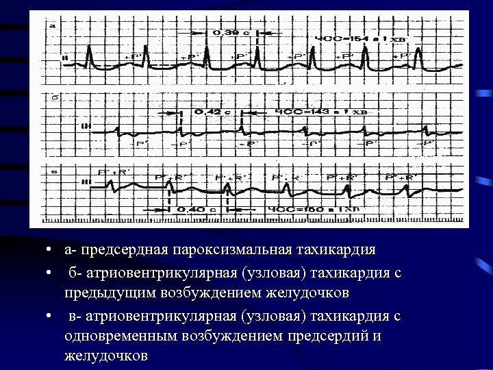 • а- предсердная пароксизмальная тахикардия • б- атриовентрикулярная (узловая) тахикардия с предыдущим возбуждением