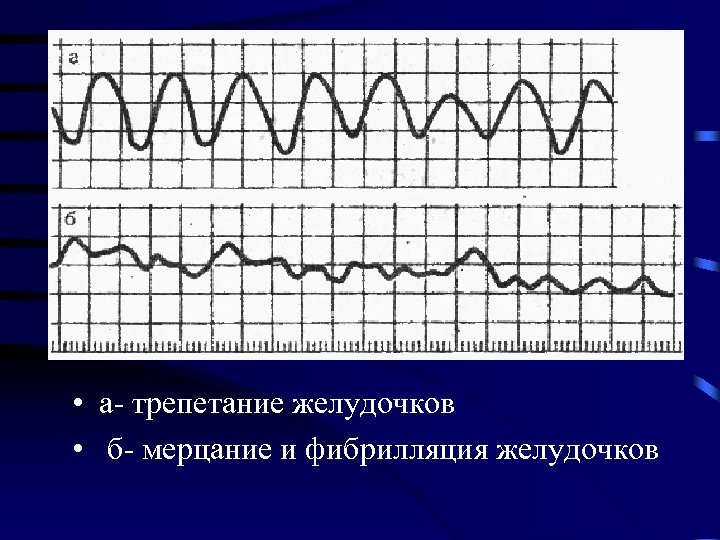  • а- трепетание желудочков • б- мерцание и фибрилляция желудочков 